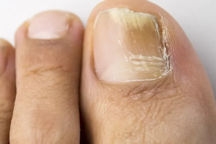 ThinkstockPhotos-478668477-promo How to get rid of toenail fungus?