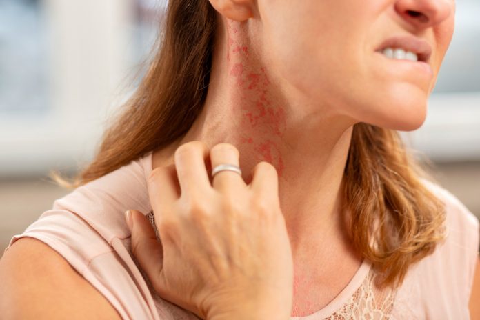 Blond woman wearing ring on finger having rash on neck How to get rid of a rash?